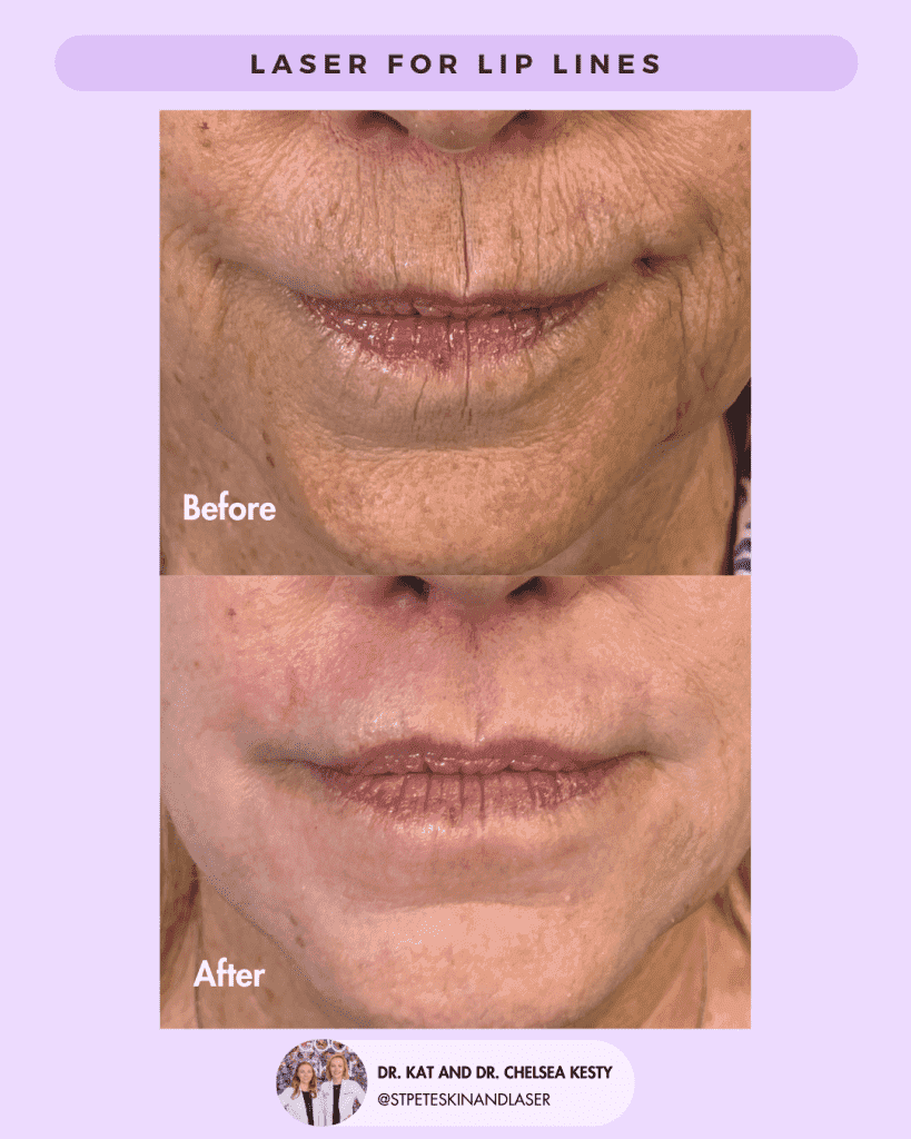 Laser Resurfacing before and after results