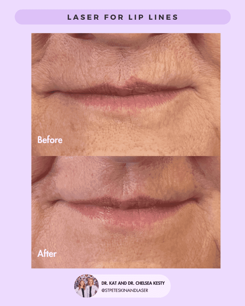 Laser Resurfacing before and after results