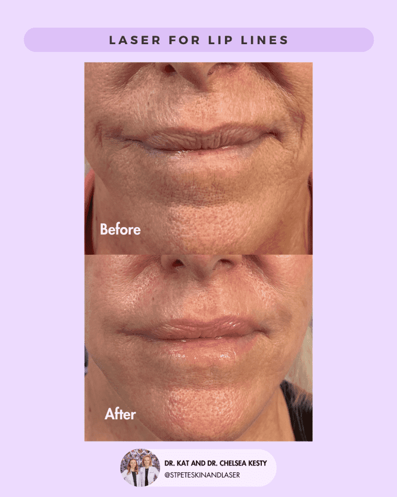 Laser Resurfacing before and after results