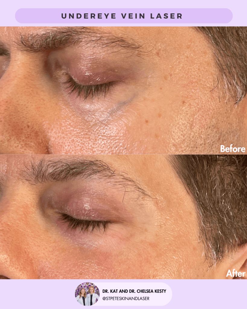 Vascular Laser before and after results