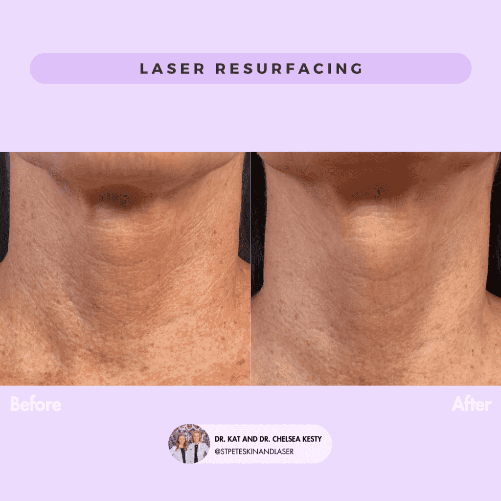 Laser Resurfacing before and after results