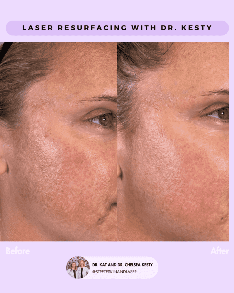 Laser Resurfacing before and after results