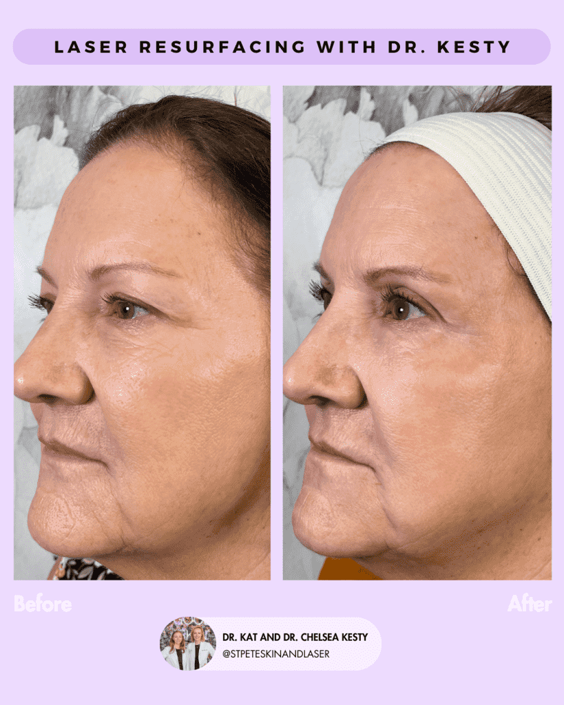 Laser Resurfacing before and after results