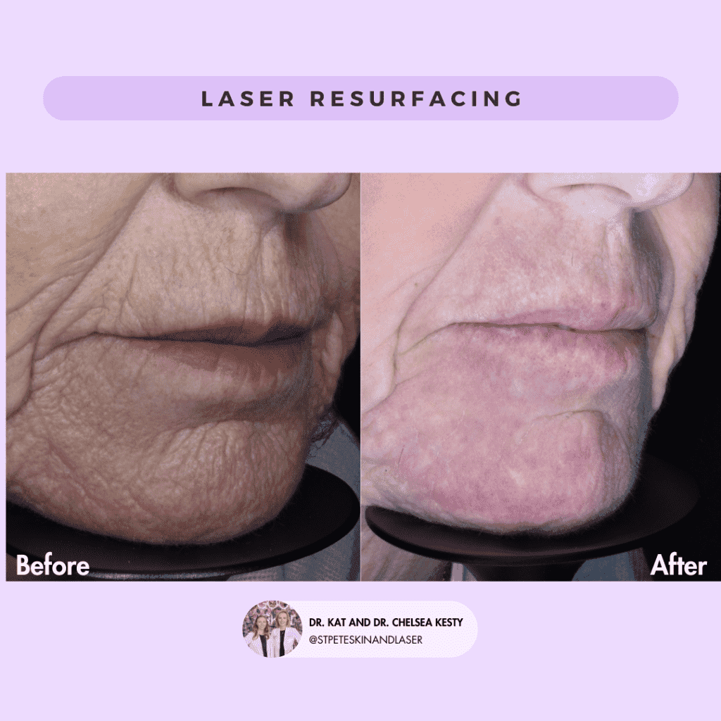 Laser Resurfacing before and after results