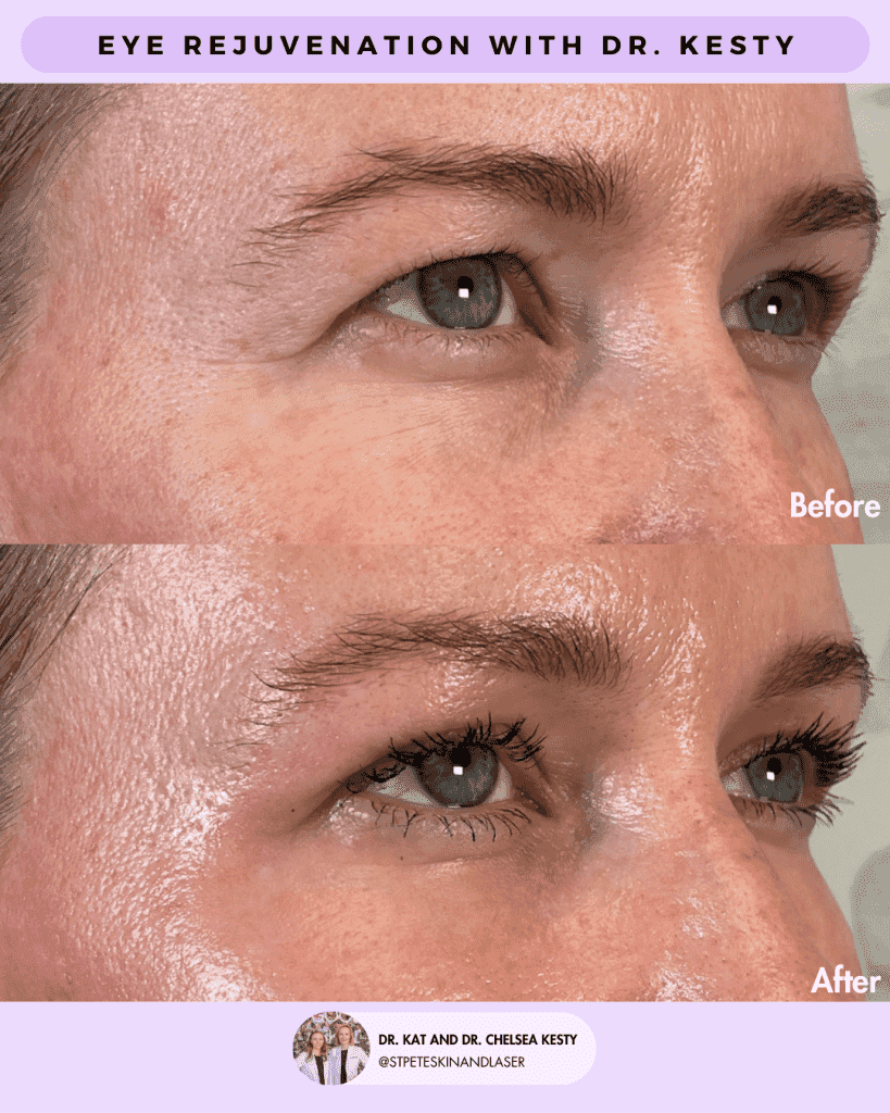 Laser Blepharoplasty before and after results