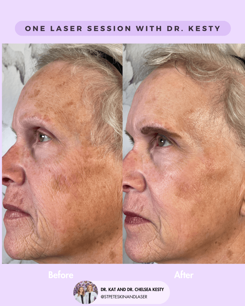 Laser Resurfacing before and after results