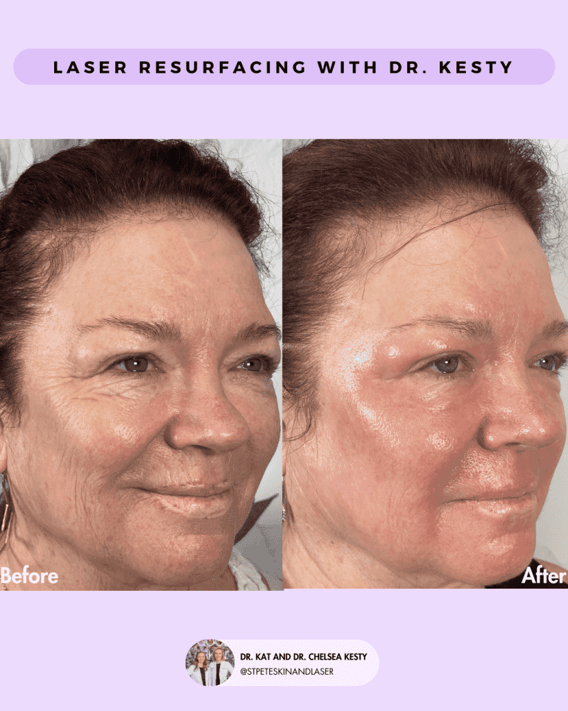 Laser Resurfacing before and after results