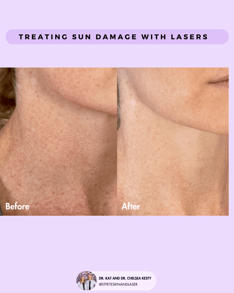 Laser Treatment of Scars before and after results