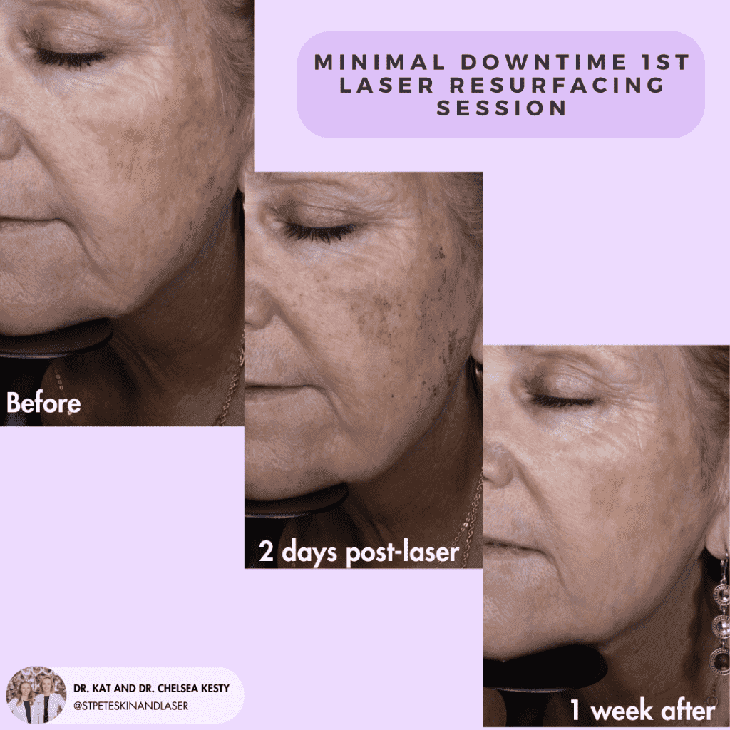 Laser Resurfacing before and after results