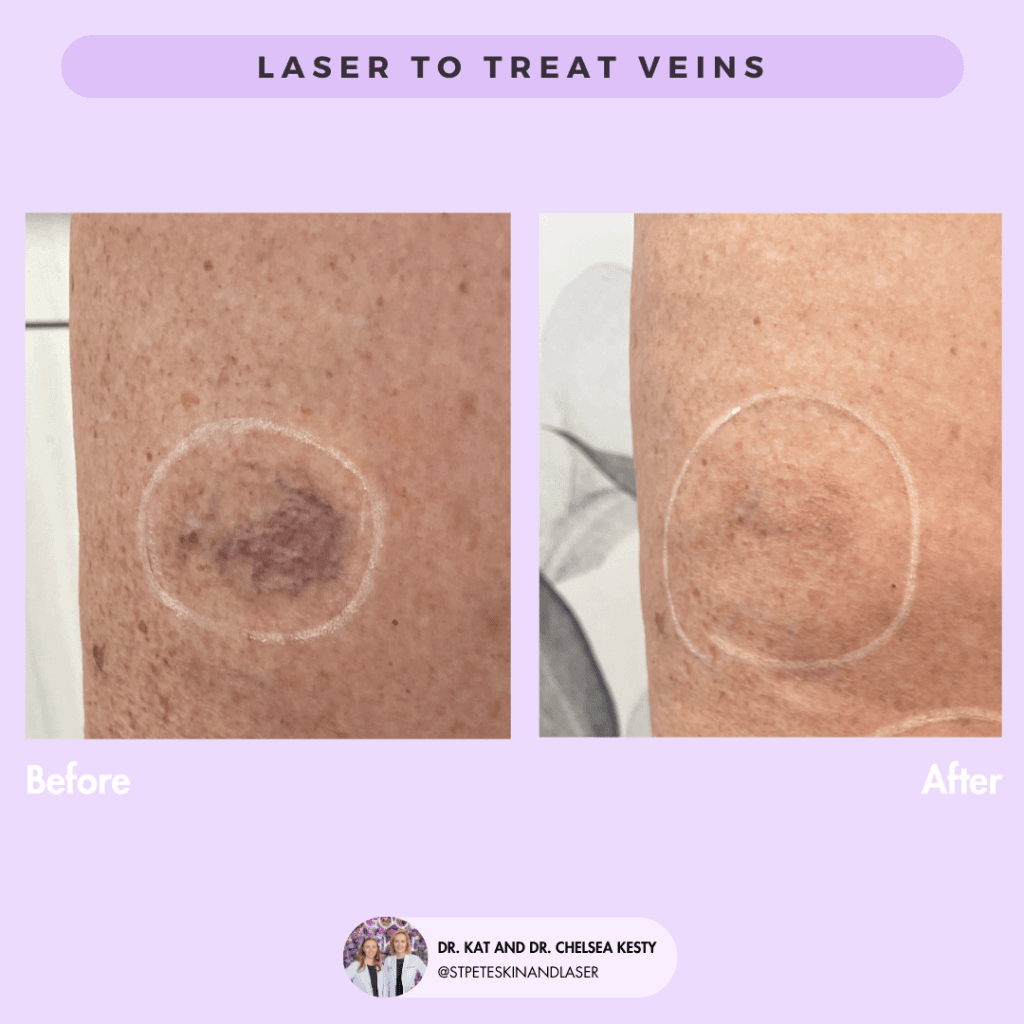 Vascular Laser before and after results