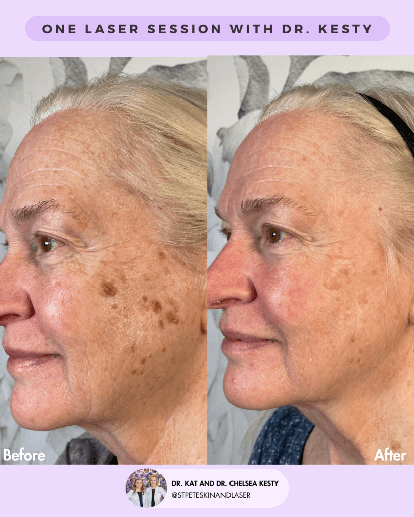 Laser Treatment of Scars before and after results