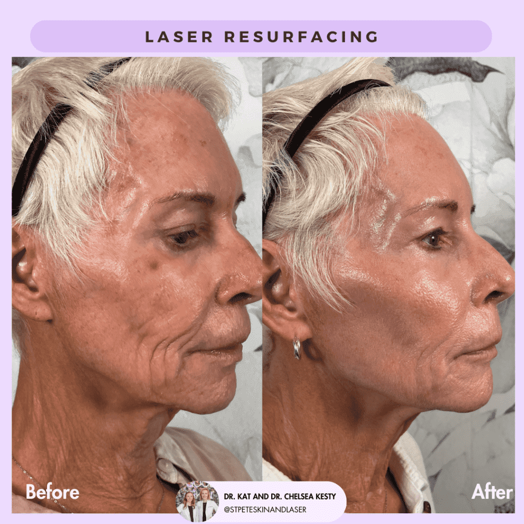 Laser Resurfacing before and after results