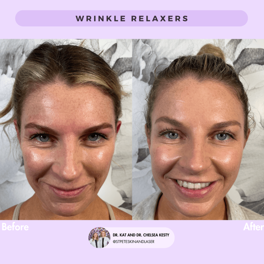 Wrinkle Relaxers before and after results