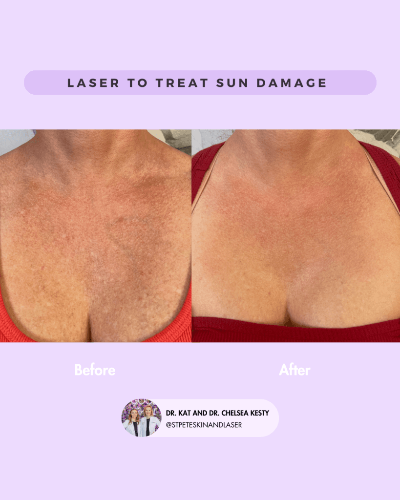 Laser Resurfacing before and after results