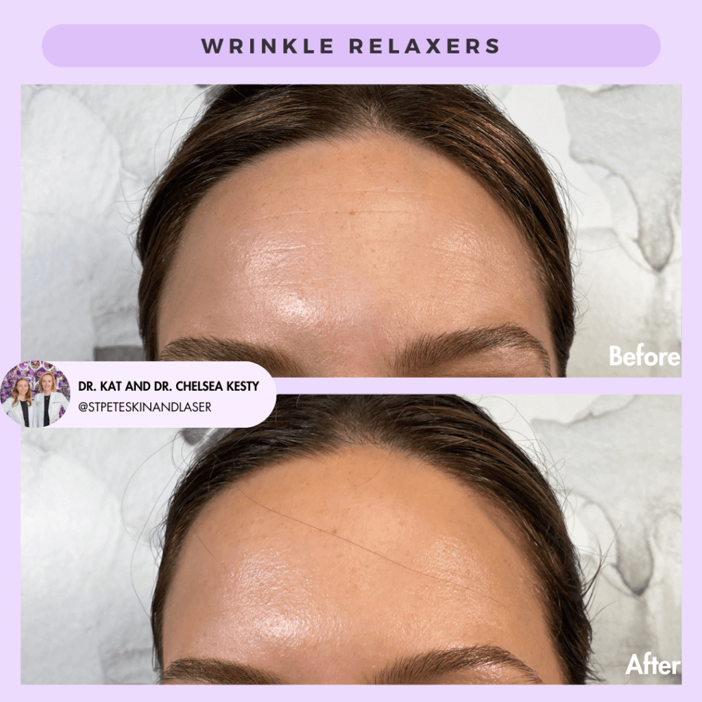 Wrinkle Relaxers before and after results