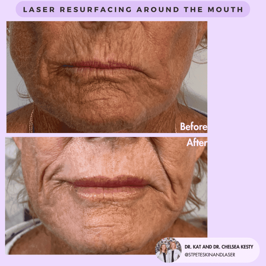 Laser Resurfacing before and after results