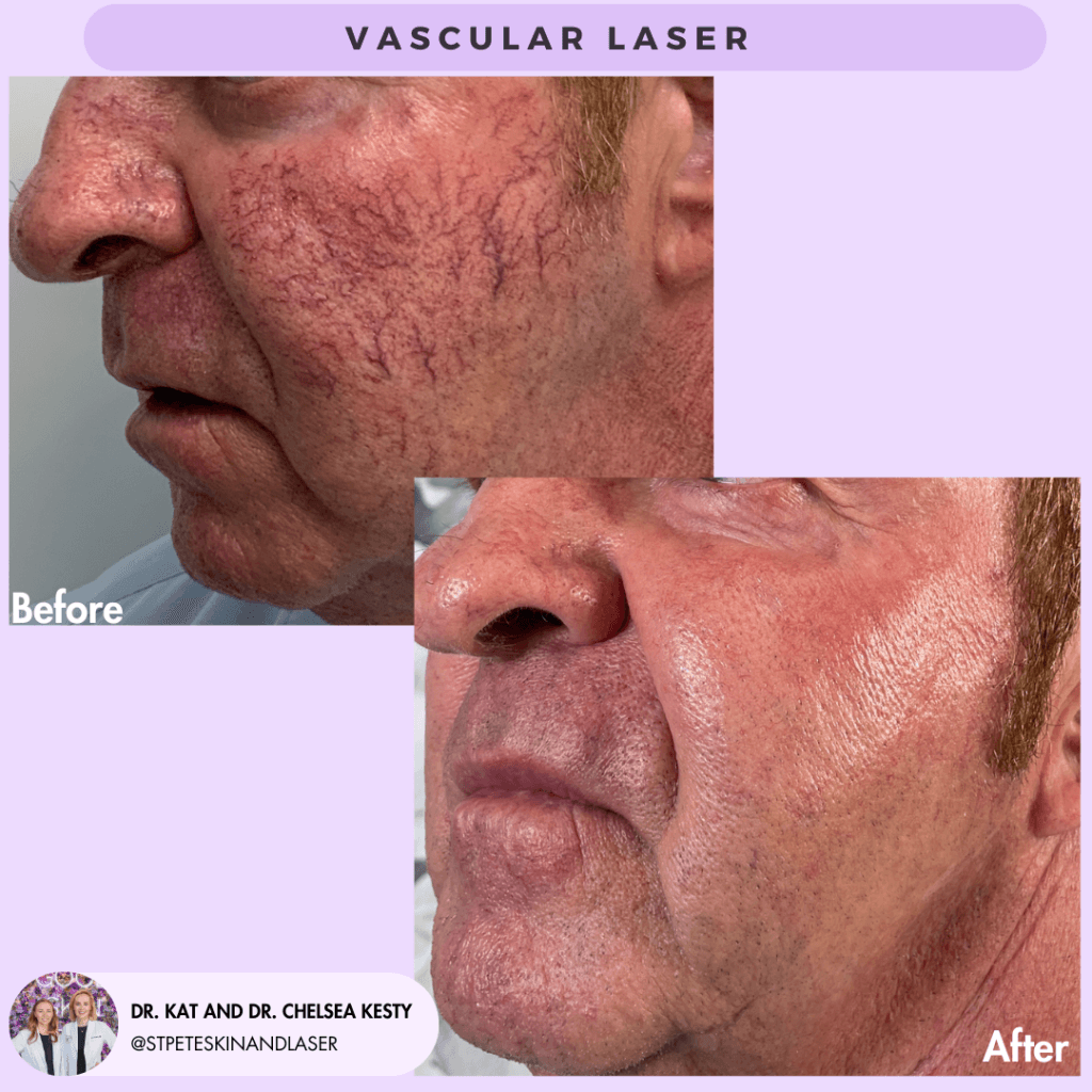 Vascular Laser before and after results