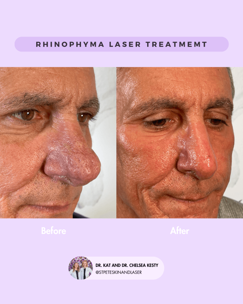 Other Cosmetic Procedures before and after results