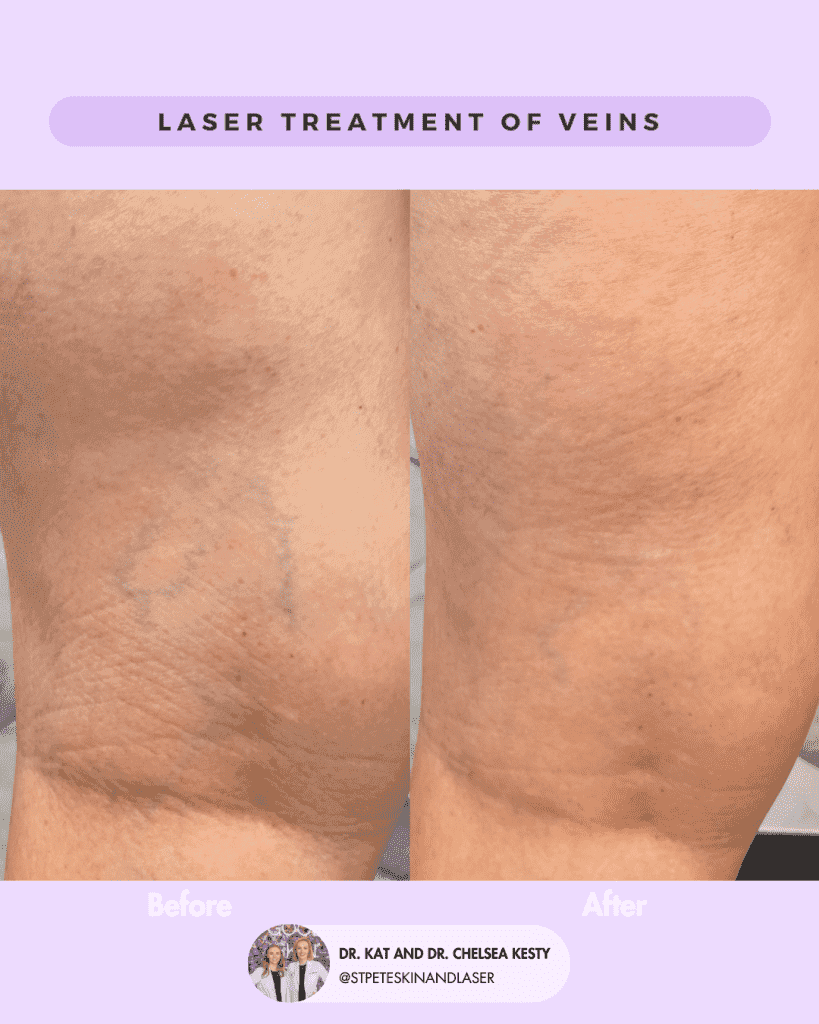 Vascular Laser before and after results