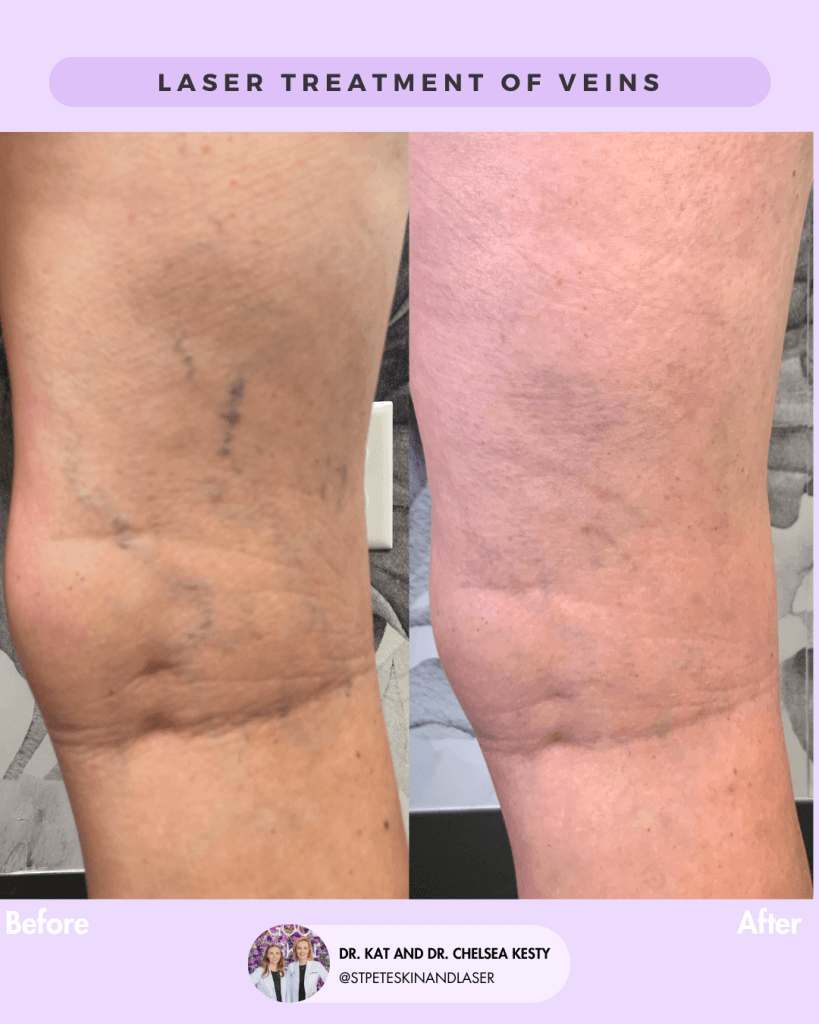 Vascular Laser before and after results