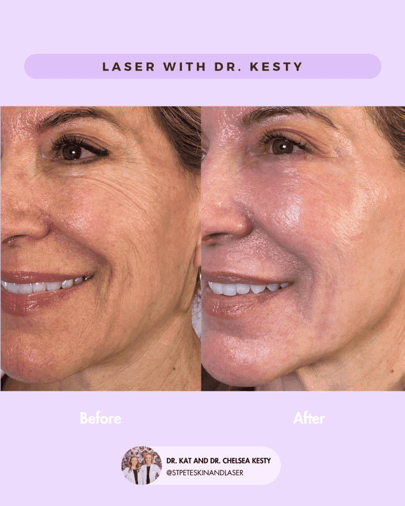 Laser Resurfacing before and after results