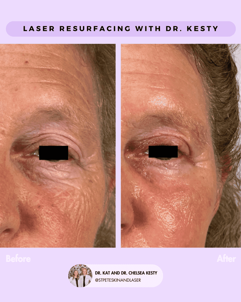 Laser Resurfacing before and after results