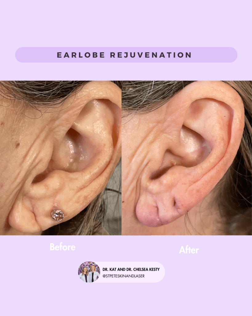 Other Cosmetic Procedures before and after results