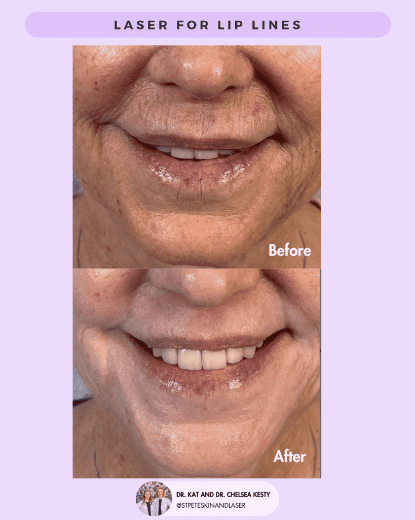 Laser Resurfacing before and after results