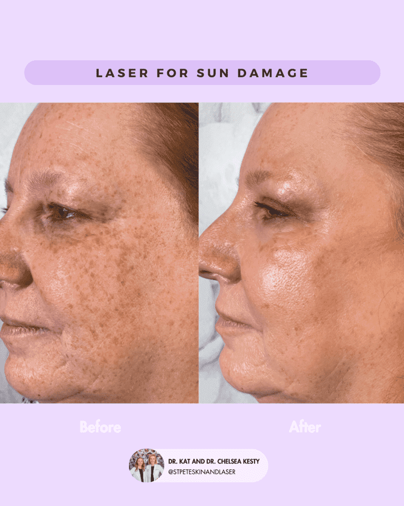 Laser Resurfacing before and after results