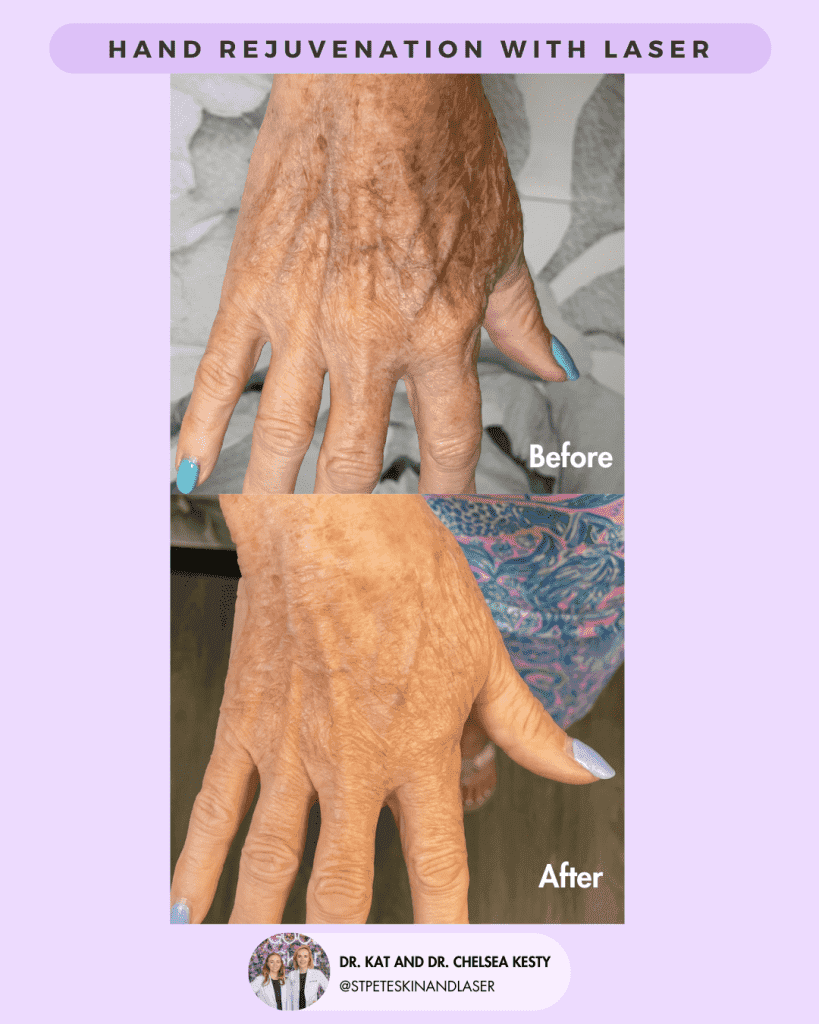 Laser Resurfacing before and after results