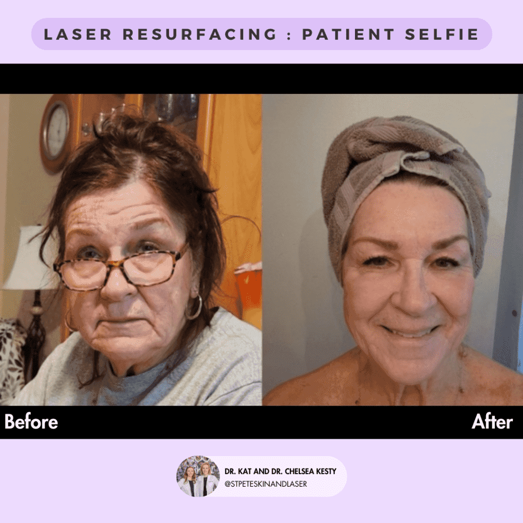 Laser Resurfacing before and after results