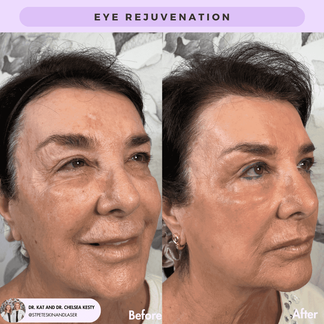 Eye Rejuvenation before and after results