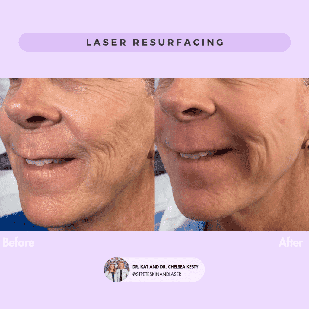 Laser Resurfacing before and after results