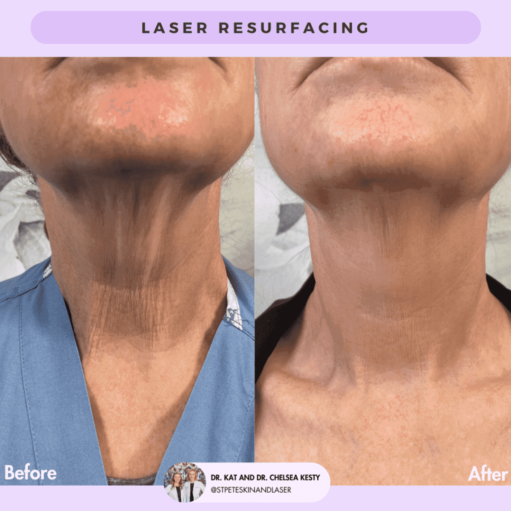 Laser Resurfacing before and after results