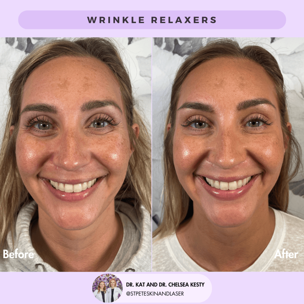 Wrinkle Relaxers before and after results