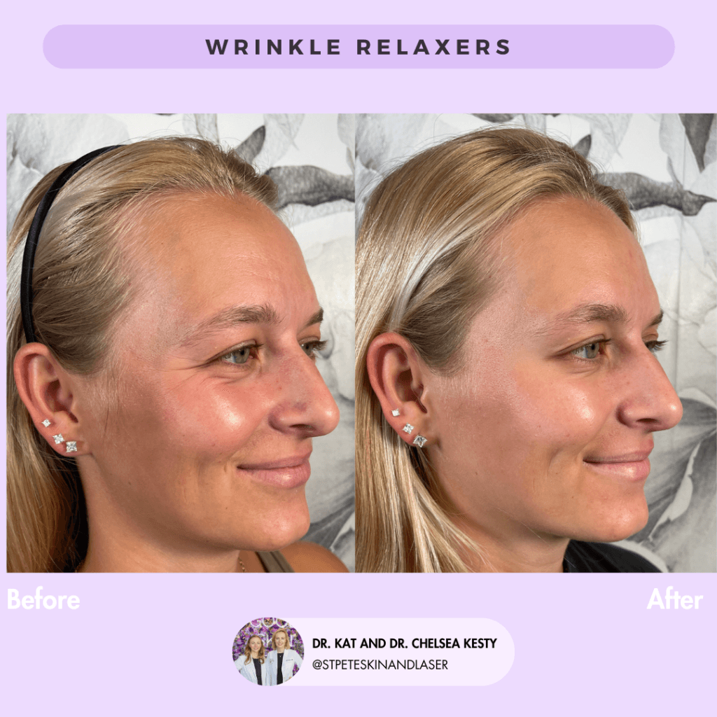 Wrinkle Relaxers before and after results