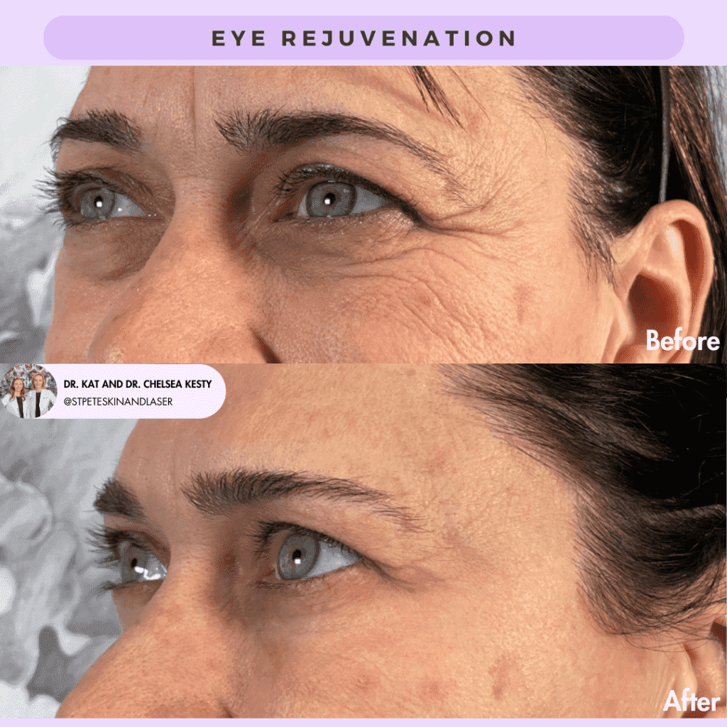 Eye Rejuvenation before and after results
