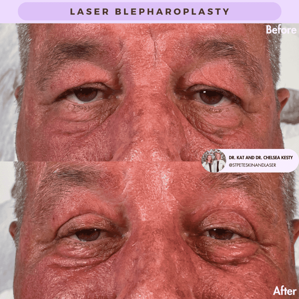 Laser Blepharoplasty before and after results
