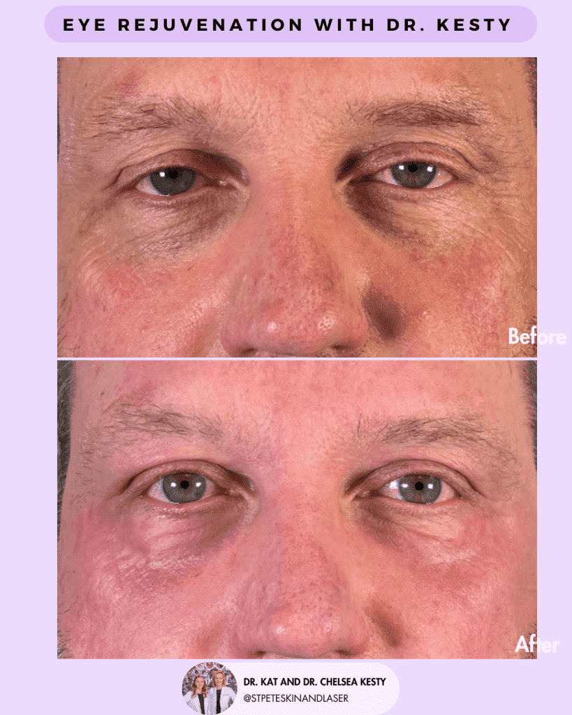 Eye Rejuvenation before and after results