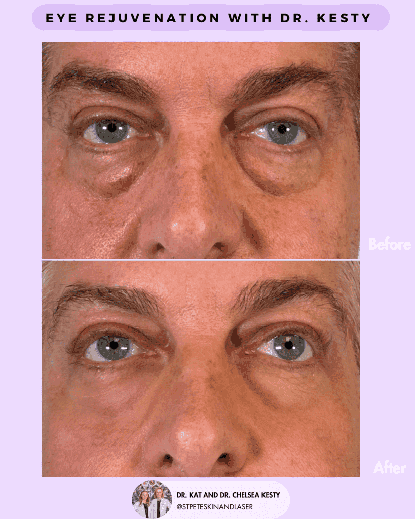Laser Blepharoplasty before and after results