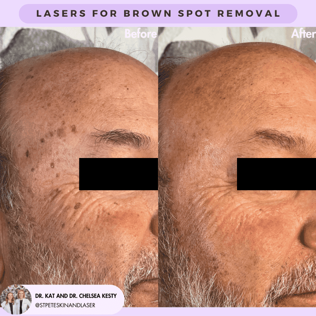 Laser Resurfacing before and after results