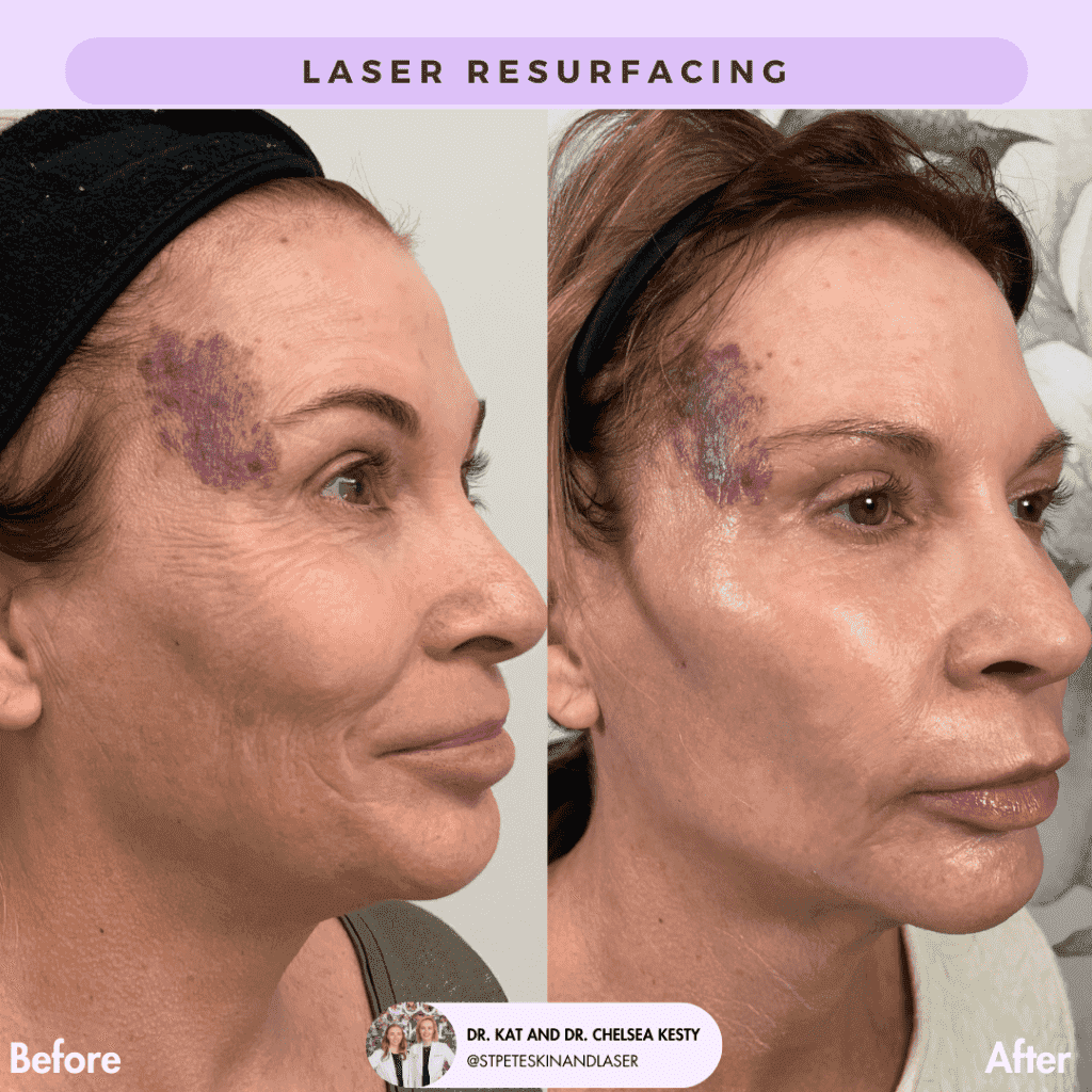 Laser Resurfacing before and after results