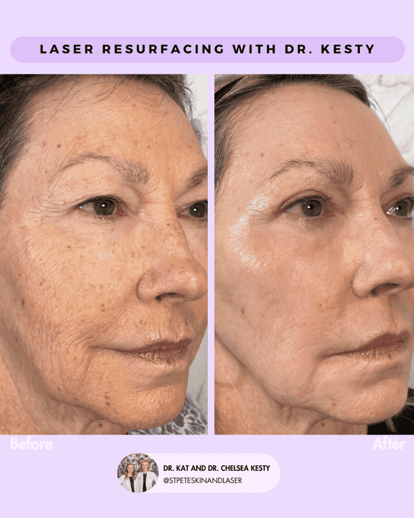 Laser Resurfacing before and after results