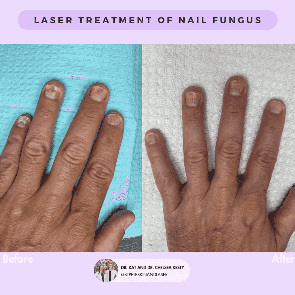 Laser Resurfacing before and after results