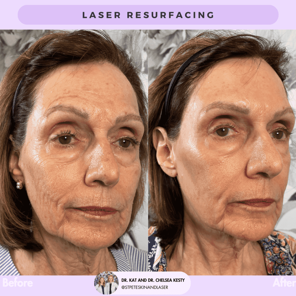 Laser Resurfacing before and after results
