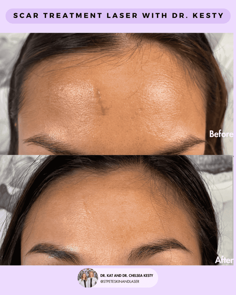 Laser Treatment of Scars before and after results