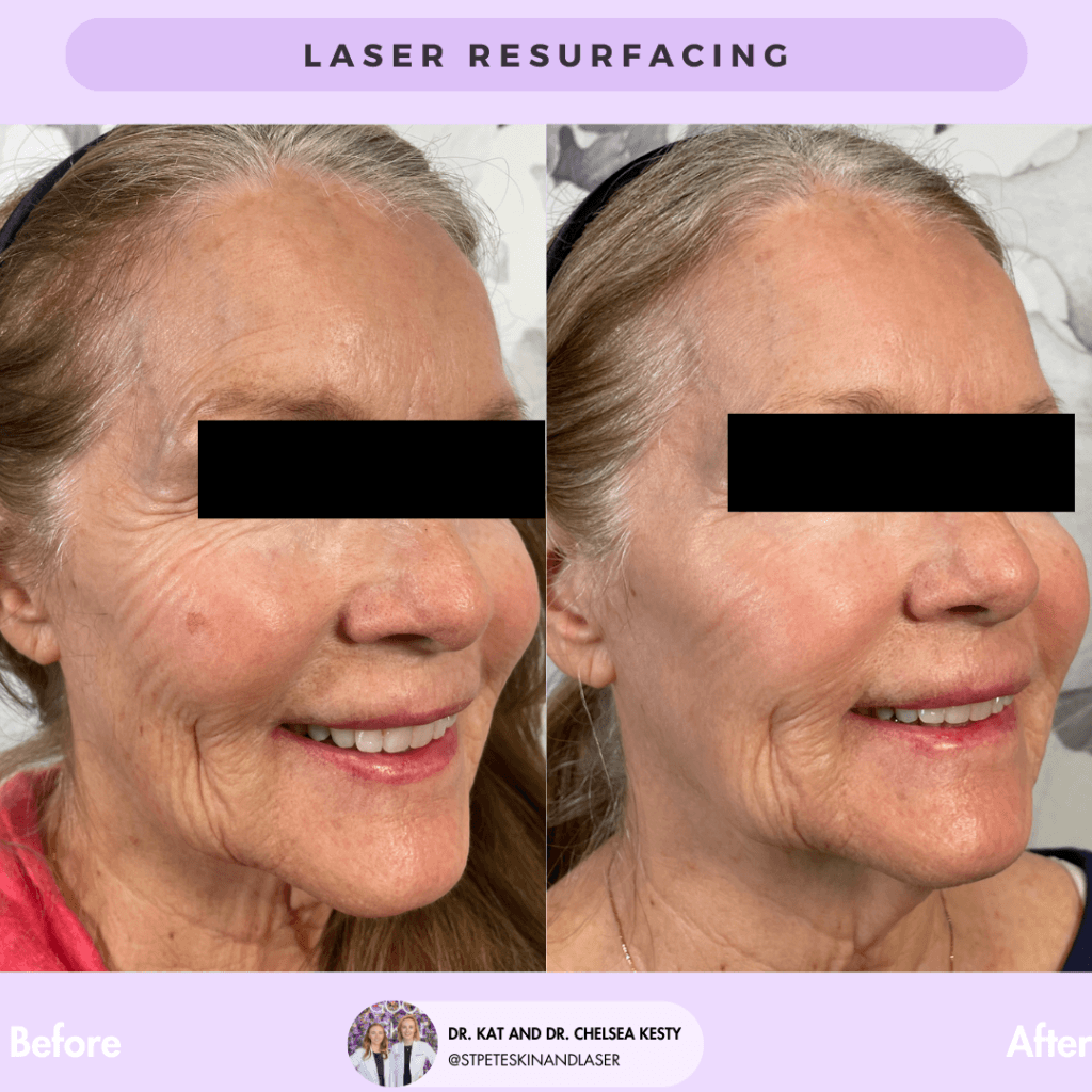 Laser Resurfacing before and after results