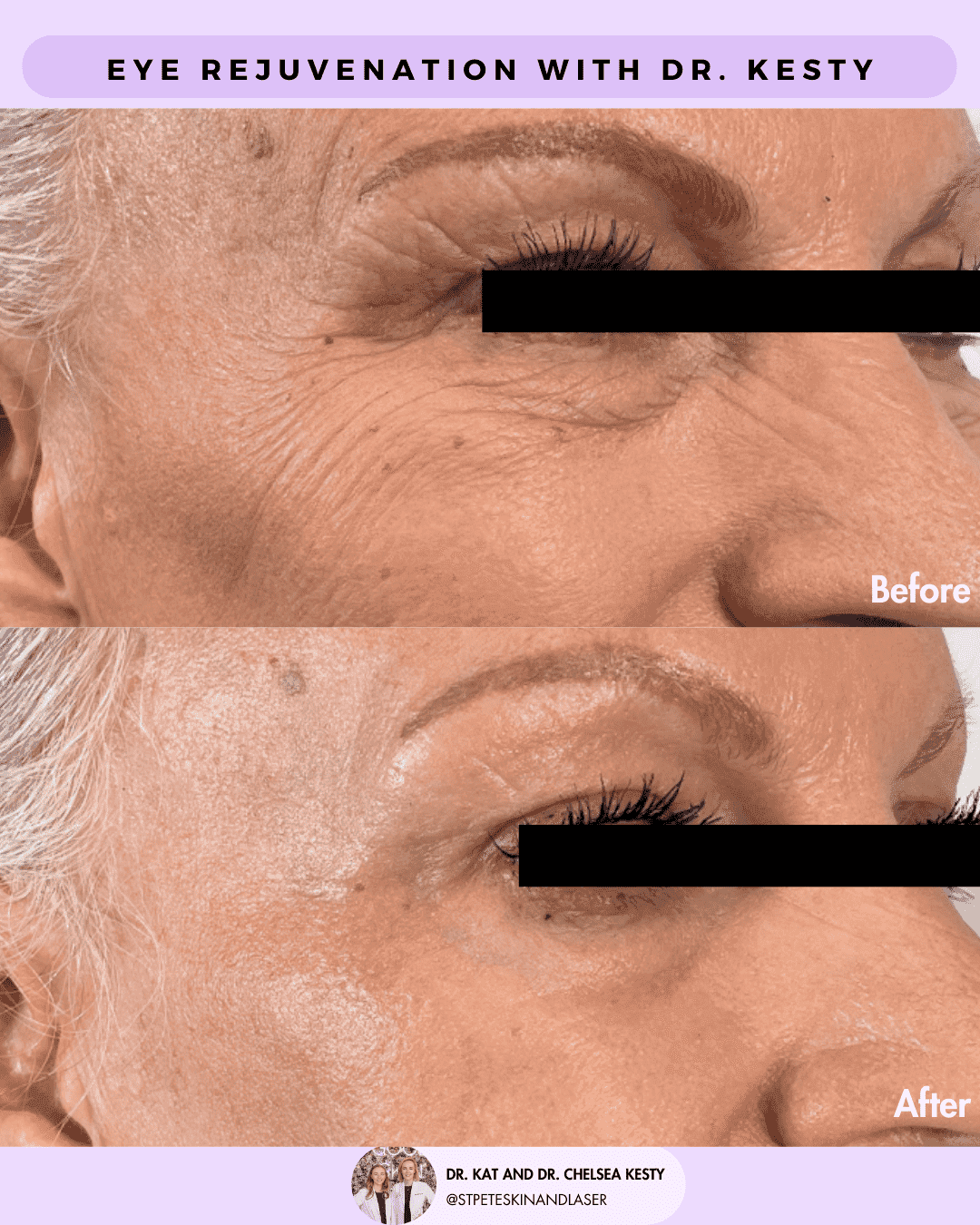 Laser Blepharoplasty before and after results