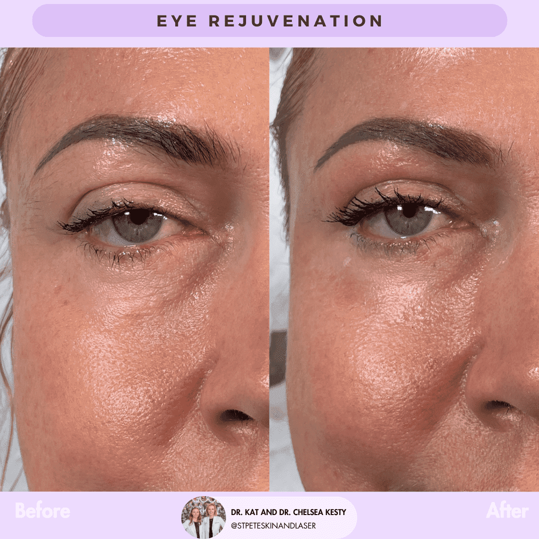 Laser Blepharoplasty before and after results
