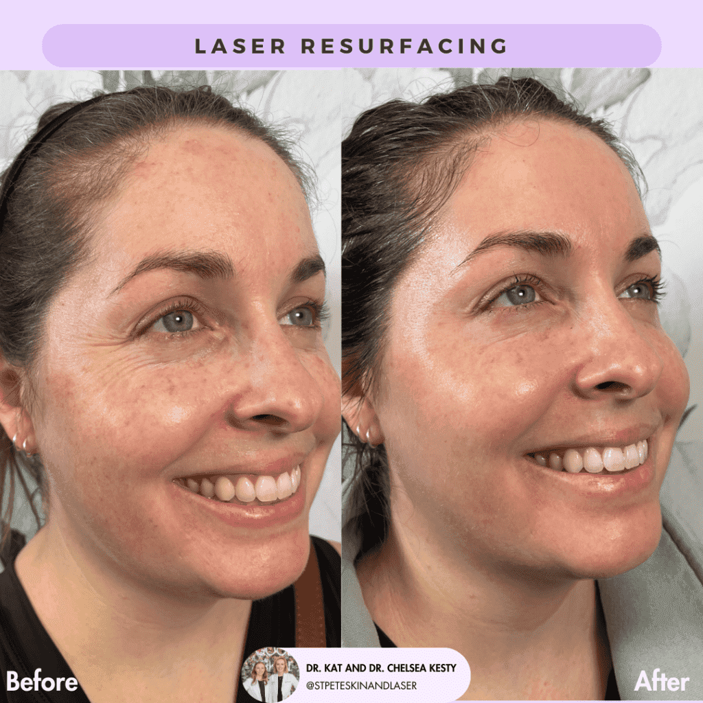 Laser Resurfacing before and after results